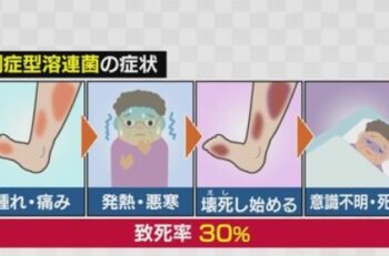 「劇症型溶連菌感染症」初の1千人超え　高い致死率、流行止まらず・・・